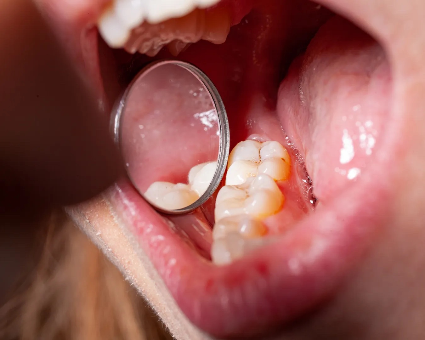 Cura di un dente cariato con lo specchietto